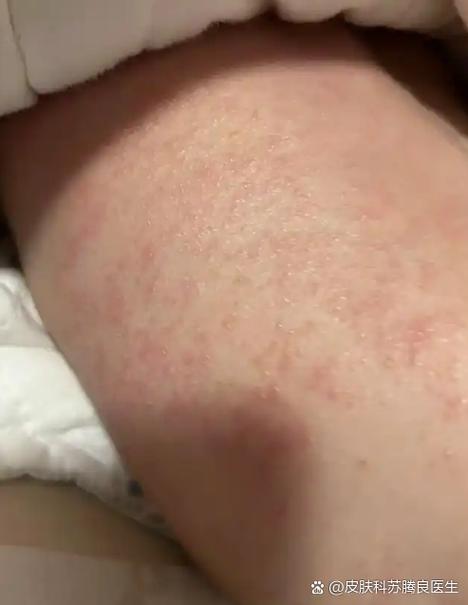 新生儿皮肤突然长红疙瘩，是湿疹、热疹还是过敏信号？-第2张图片-郑州医学网
