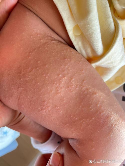新生儿皮肤突然长红疙瘩，是湿疹、热疹还是过敏信号？-第1张图片-郑州医学网