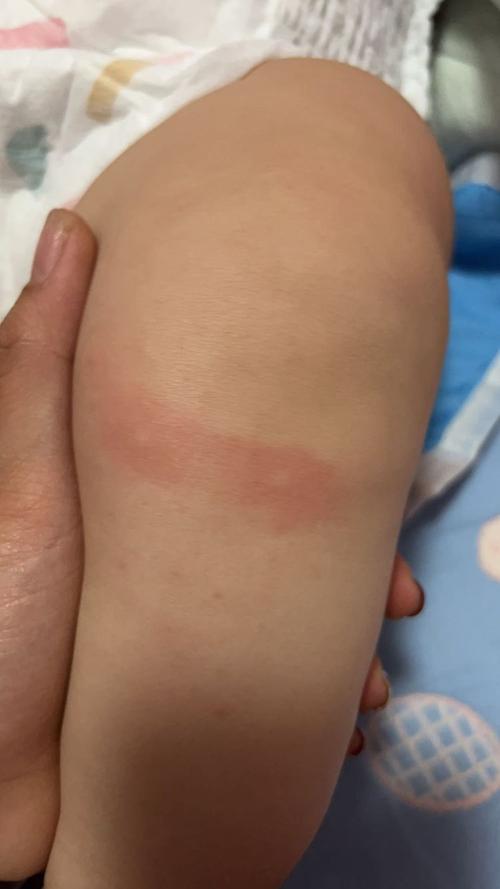 新生儿皮肤突然长红疙瘩，是湿疹、热疹还是过敏信号？-第3张图片-郑州医学网