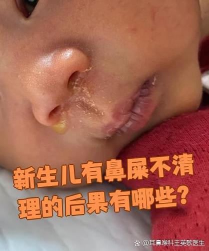 新生儿鼻腔为何总有鼻屎？是正常现象还是生病信号？-第2张图片-郑州医学网