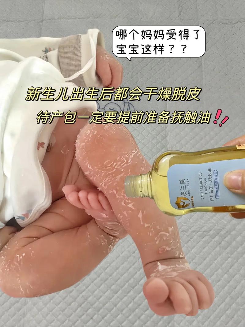新生儿皮肤干燥擦什么？安全有效的保湿产品怎么选？-第1张图片-郑州医学网
