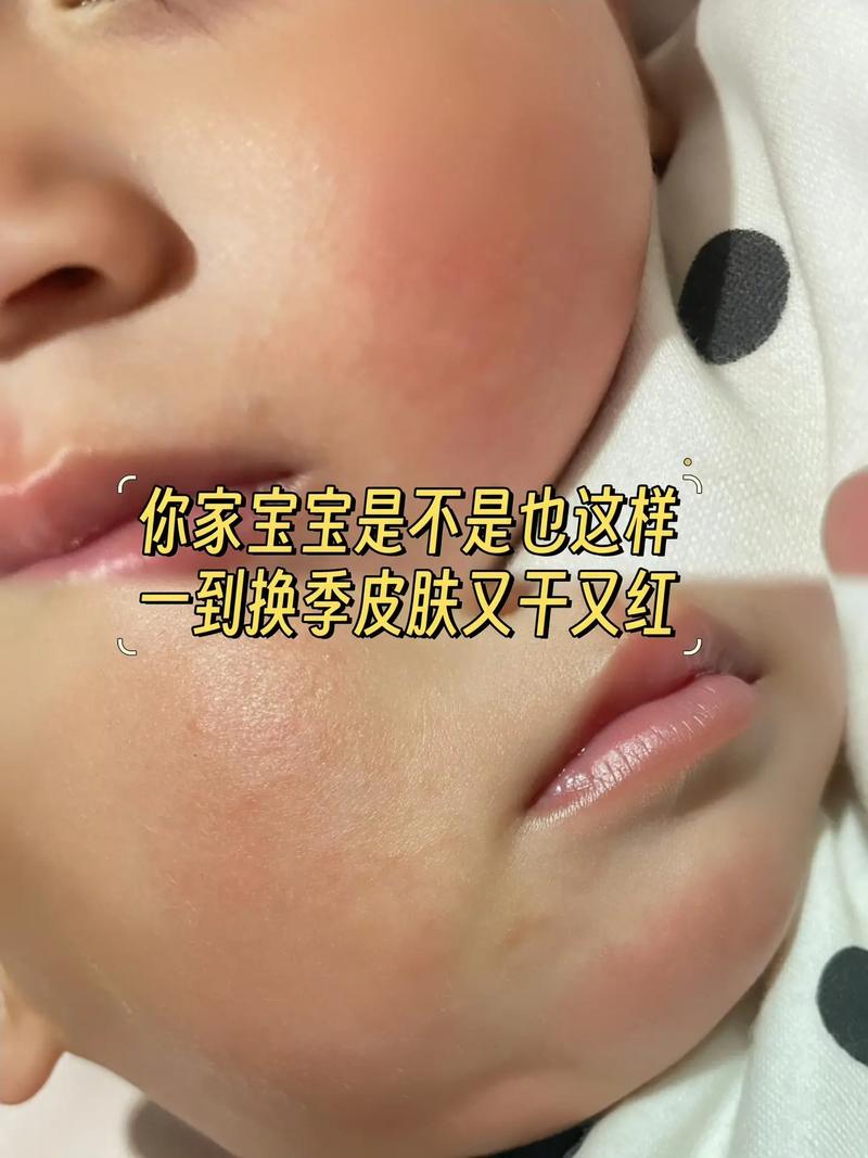 新生儿皮肤干燥擦什么？安全有效的保湿产品怎么选？-第3张图片-郑州医学网