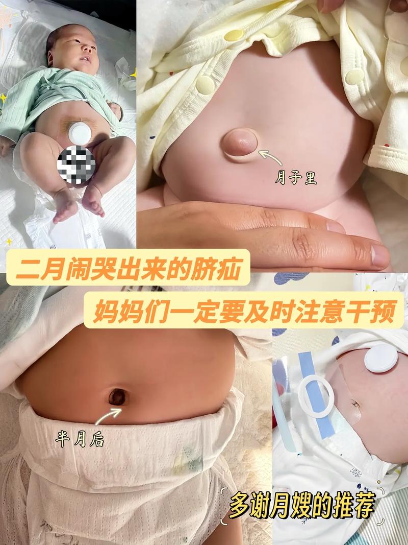 新生儿脐疝一定要手术吗？有哪些非手术治疗方法有效？-第3张图片-郑州医学网