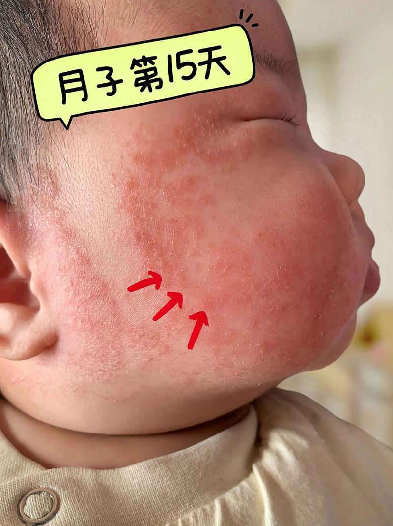 新生儿脸上湿疹抹什么-第3张图片-郑州医学网