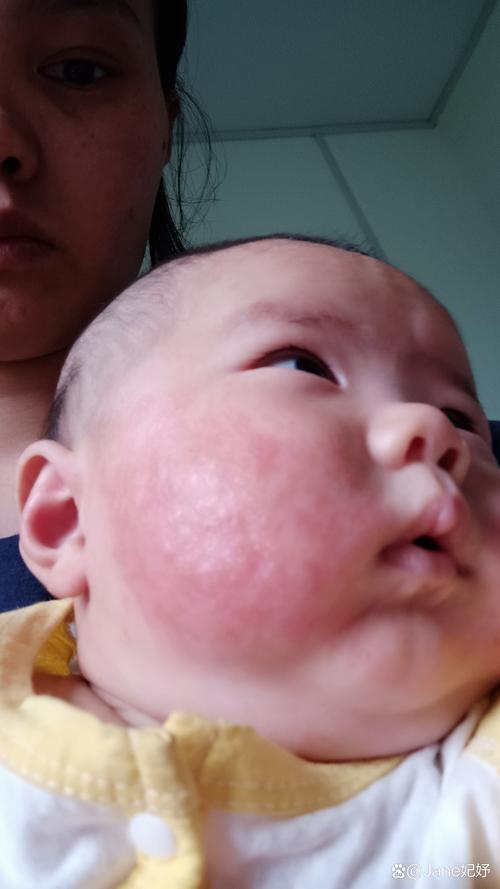 新生儿脸上湿疹抹什么-第2张图片-郑州医学网