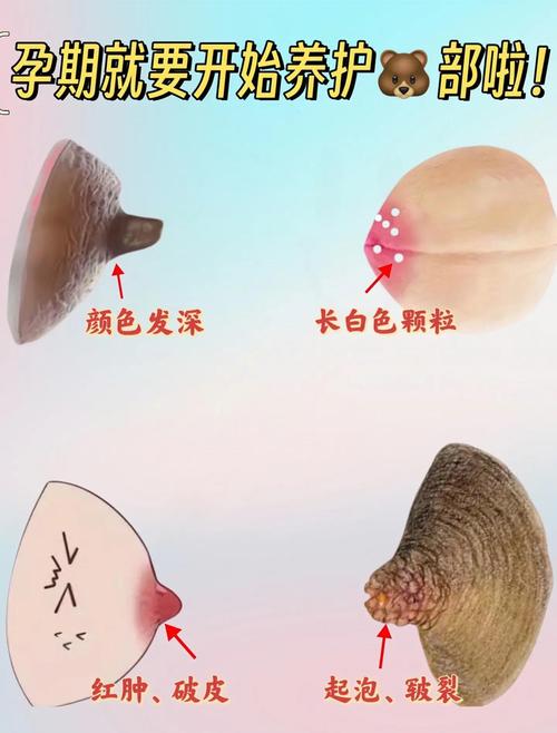 孕期乳头出现白色分泌物是正常现象吗？需要处理吗？-第2张图片-郑州医学网