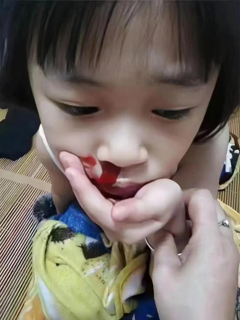 儿童高烧后为何会鼻子流血？是正常现象还是疾病信号？-第2张图片-郑州医学网
