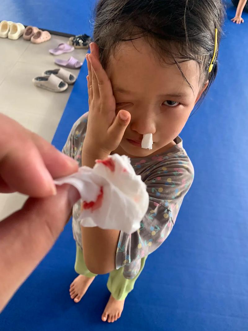 儿童高烧后为何会鼻子流血？是正常现象还是疾病信号？-第1张图片-郑州医学网