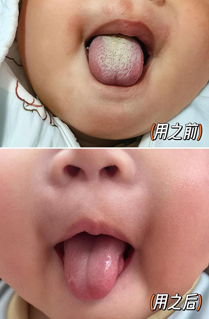 儿童舌头健康状态图鉴，如何通过图片区分正常与异常？-第3张图片-郑州医学网