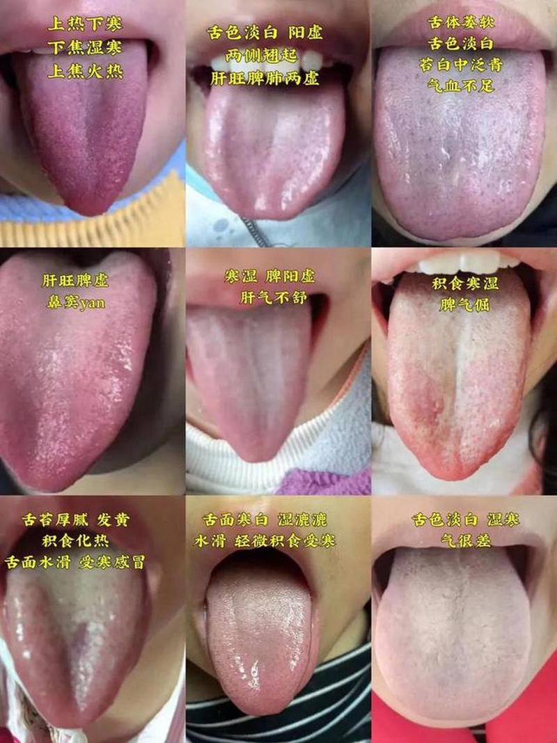 儿童舌头健康状态图鉴，如何通过图片区分正常与异常？-第2张图片-郑州医学网