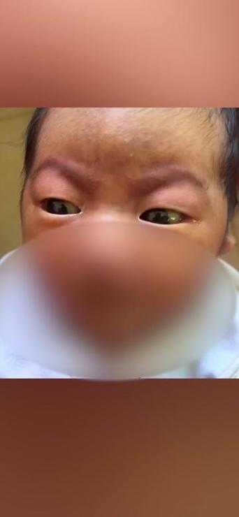 新生儿眼睛发黄严重吗？需要警惕哪些潜在健康风险？-第2张图片-郑州医学网