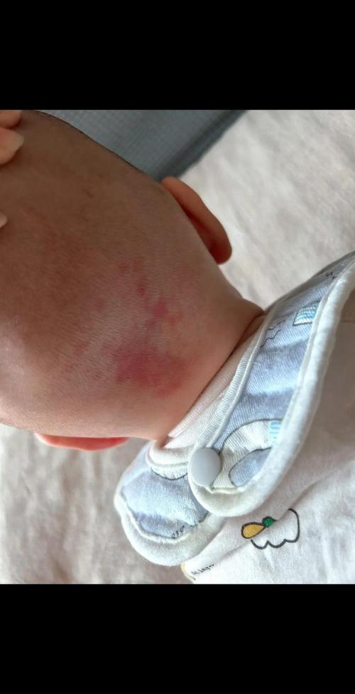 新生儿红斑消退过程是自然现象吗？需要家长如何正确护理？-第2张图片-郑州医学网