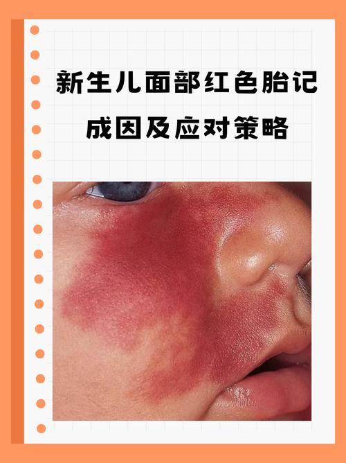 新生儿红斑消退过程是自然现象吗？需要家长如何正确护理？-第3张图片-郑州医学网