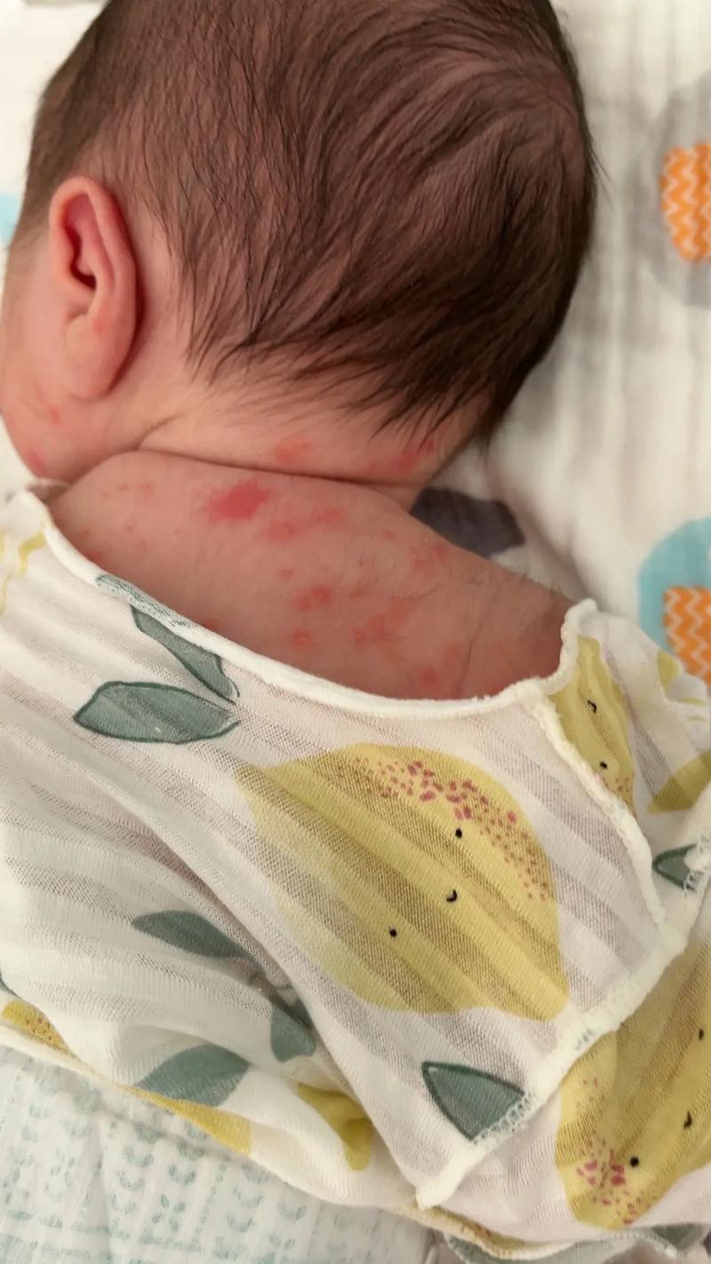 新生儿红斑消退过程是自然现象吗？需要家长如何正确护理？-第1张图片-郑州医学网
