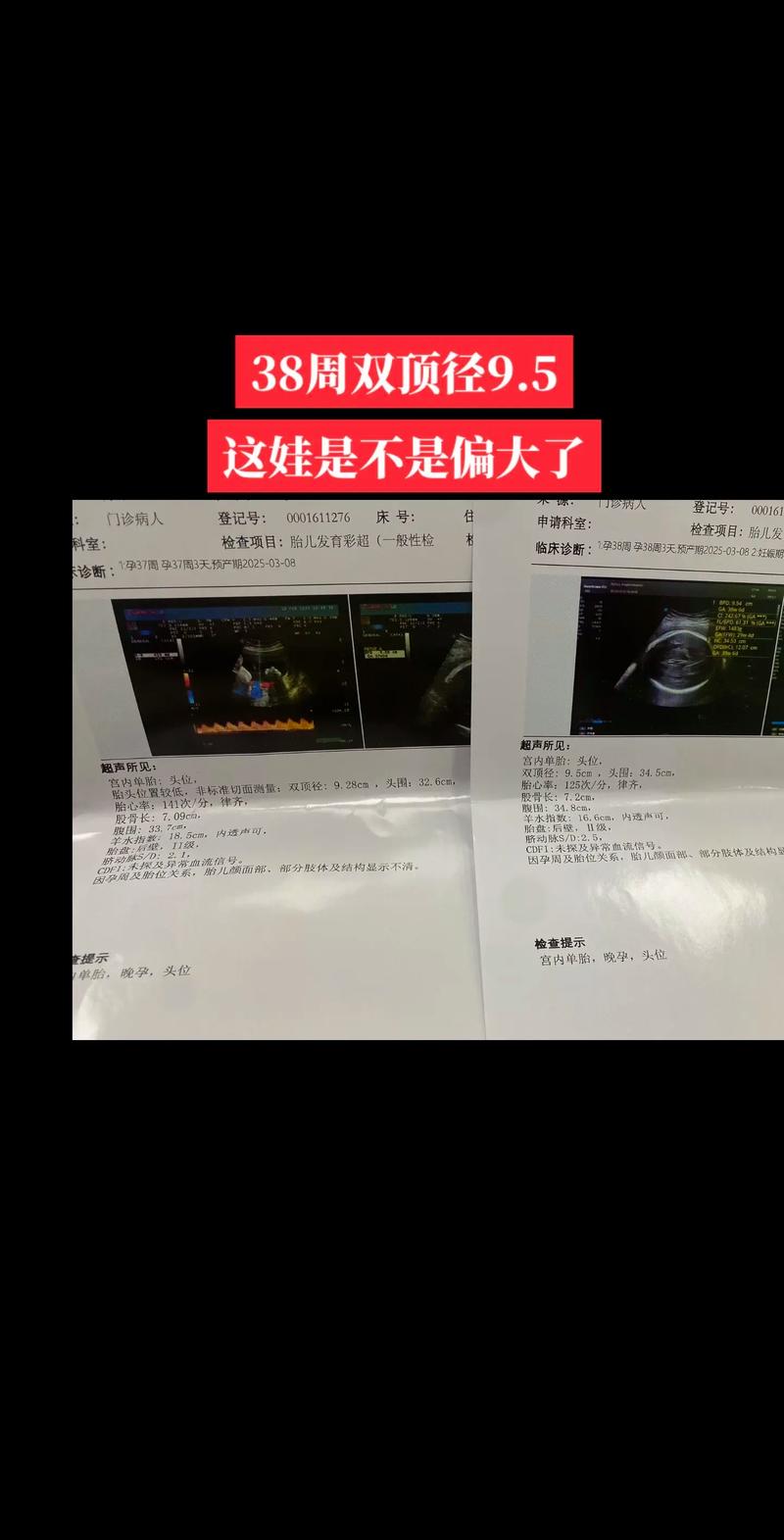 孕期宝宝偏大是营养过剩还是其他因素在作祟？-第2张图片-郑州医学网