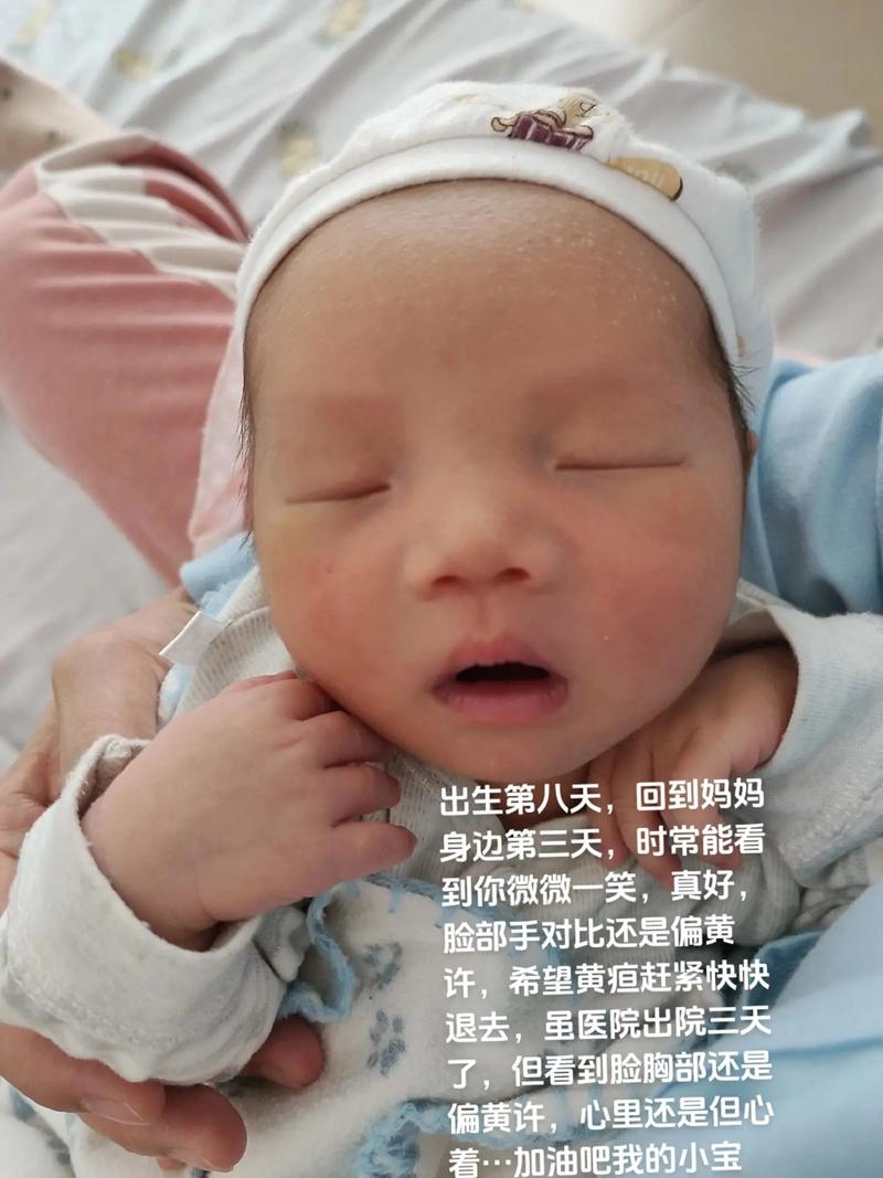 新生儿溶血症究竟多久能好？治疗周期与恢复时间受哪些因素影响？-第2张图片-郑州医学网