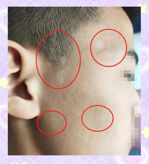 安徽儿童白斑治疗选华夏仁心是否靠谱?专家团队与康复案例怎么样?-第2张图片-郑州医学网 安徽儿童白斑治疗选华夏仁心是否靠谱?专家团队与康复案例怎么样?-第2张图片-郑州医学网