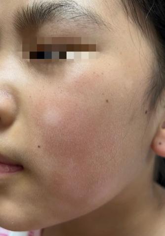 安徽儿童白斑治疗选华夏仁心是否靠谱?专家团队与康复案例怎么样?-第3张图片-郑州医学网 安徽儿童白斑治疗选华夏仁心是否靠谱?专家团队与康复案例怎么样?-第3张图片-郑州医学网