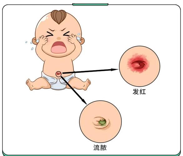 新生儿脐带感染的症状-第1张图片-郑州医学网