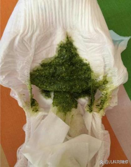 新生儿大便出现绿色便便，是正常现象还是健康警报？-第1张图片-郑州医学网