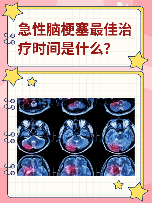 新生儿脑梗塞有哪些安全有效的治疗方法？-第3张图片-郑州医学网