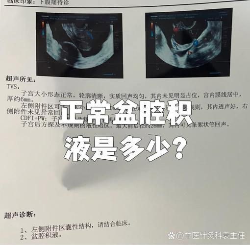 孕期盆腔积液会流血吗-第2张图片-郑州医学网