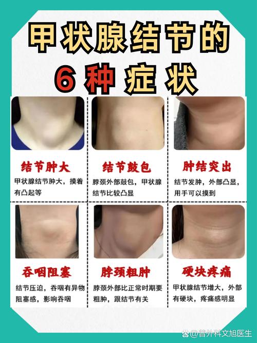 13岁儿童甲状腺结节是何原因？需警惕吗？如何科学干预？-第2张图片-郑州医学网