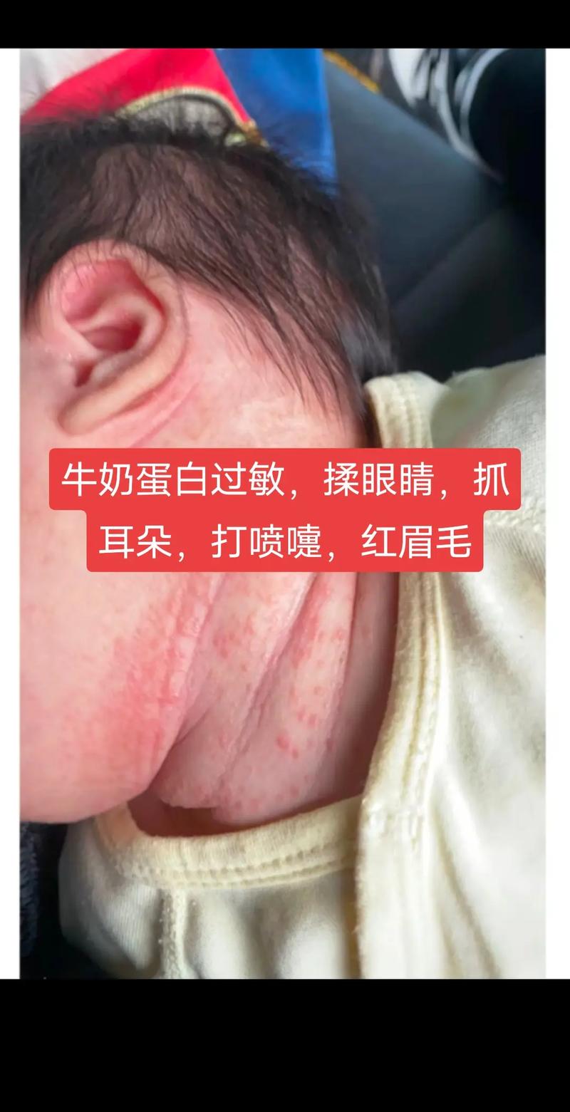 新生儿对牛奶蛋白过敏-第2张图片-郑州医学网 新生儿对牛奶蛋白过敏-第2张图片-郑州医学网
