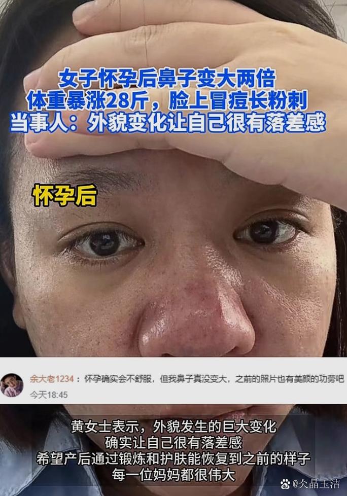 孕期为什么鼻子会变大-第3张图片-郑州医学网