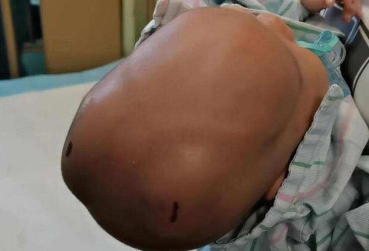 新生儿硬肿症的并发症-第3张图片-郑州医学网