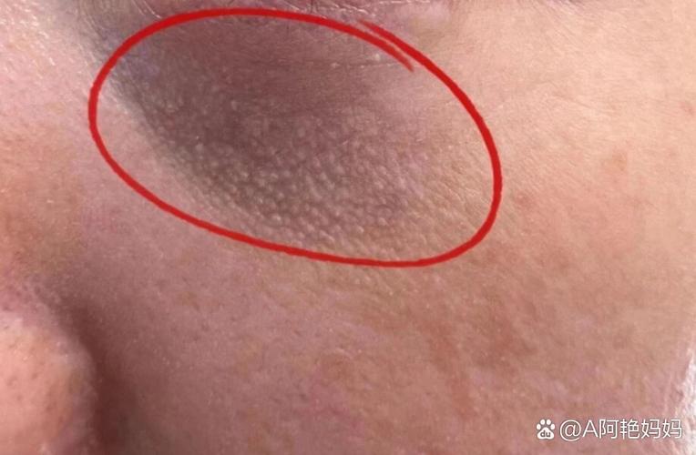 孕期眼睛下面长小疙瘩-第2张图片-郑州医学网