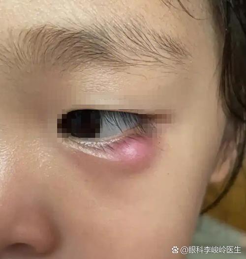 孕期眼睛下面长小疙瘩-第1张图片-郑州医学网 孕期眼睛下面长小疙瘩-第1张图片-郑州医学网