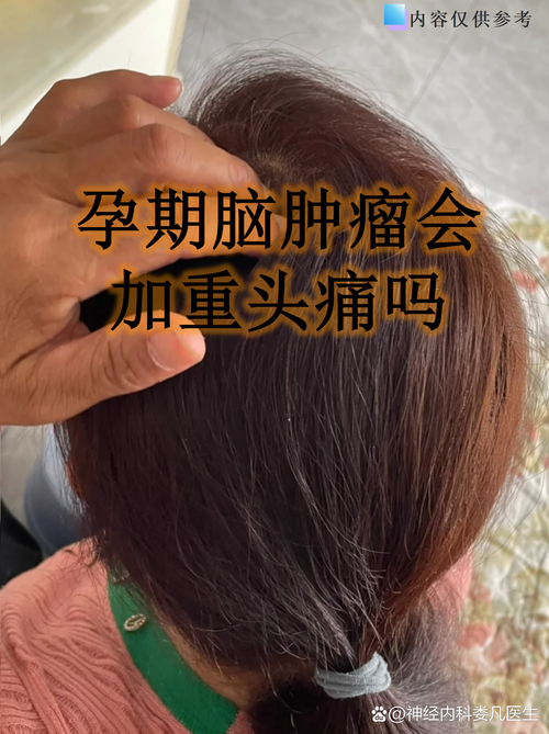 孕期头疼什么时候结束-第3张图片-郑州医学网