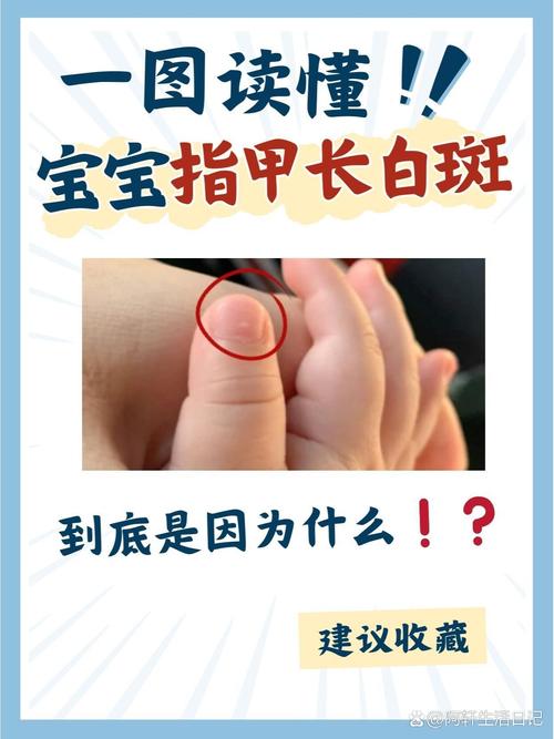 新生儿手白怎么回事啊-第1张图片-郑州医学网