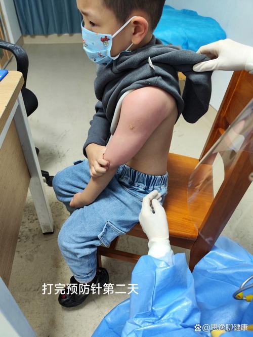 儿童大腿外侧接种图片-第2张图片-郑州医学网