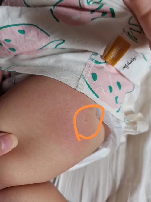 儿童大腿外侧接种图片-第1张图片-郑州医学网