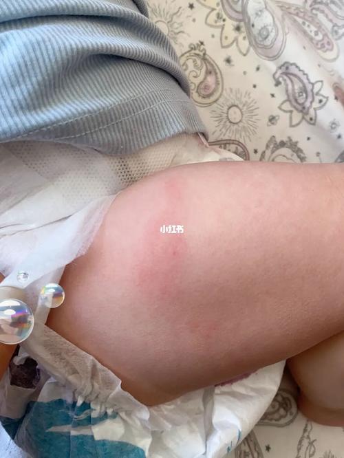 儿童大腿外侧接种图片-第3张图片-郑州医学网