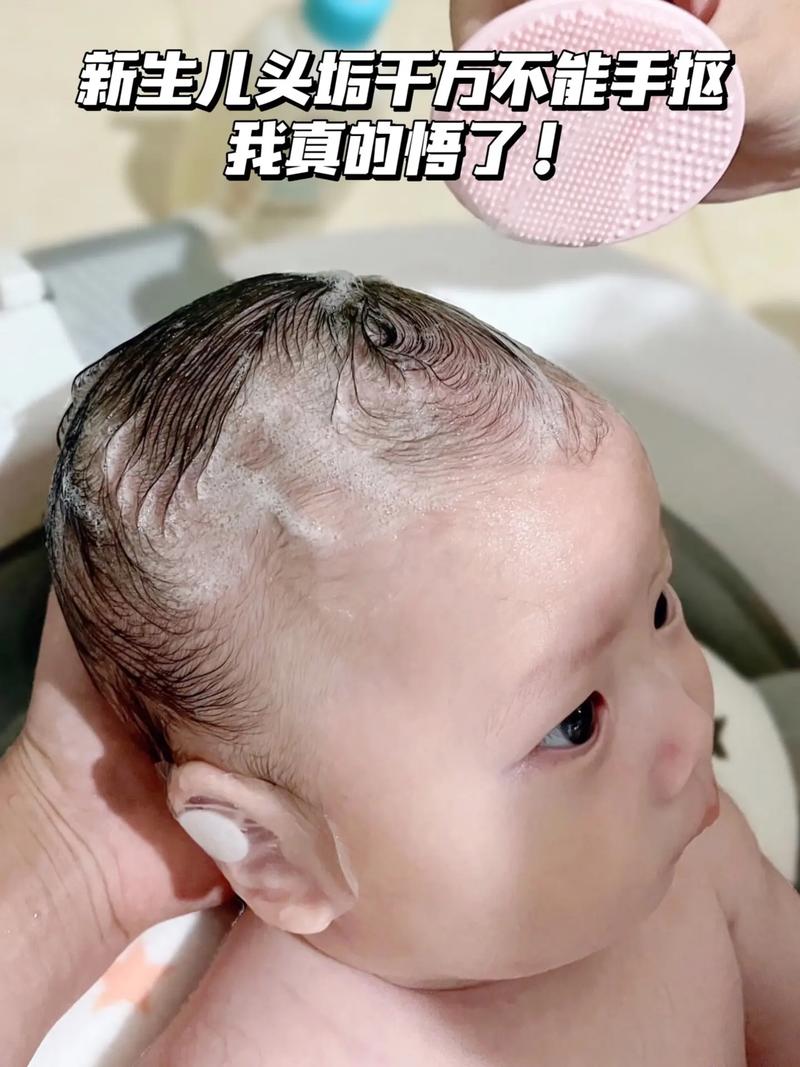 新生儿头烫是怎么回事-第2张图片-郑州医学网 新生儿头烫是怎么回事-第2张图片-郑州医学网