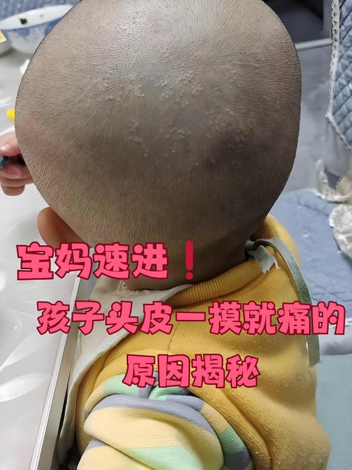 新生儿头烫是怎么回事-第3张图片-郑州医学网 新生儿头烫是怎么回事-第3张图片-郑州医学网