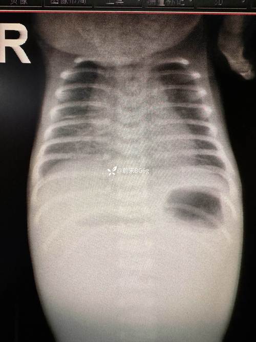 新生儿接受X光检查会有哪些潜在影响与风险？-第3张图片-郑州医学网