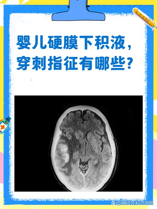 新生儿双侧硬膜下积液，病因、诊断与治疗全解析-第1张图片-郑州医学网