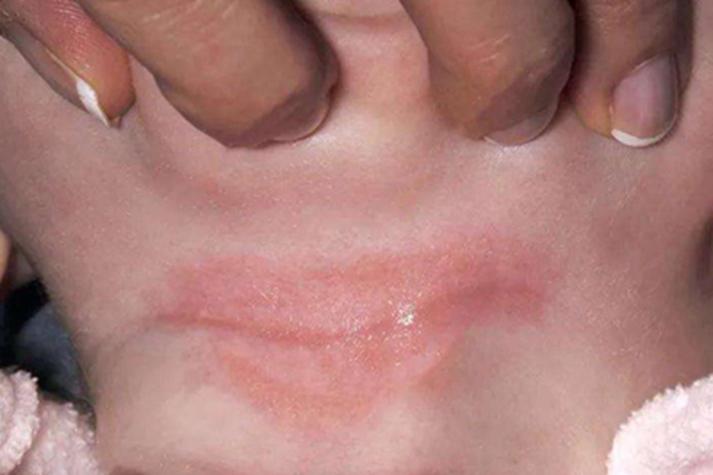 儿童渗出性多形性红斑-第1张图片-郑州医学网