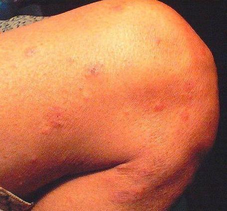 儿童渗出性多形性红斑-第3张图片-郑州医学网