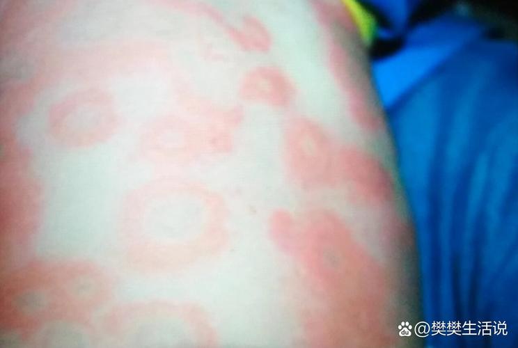 儿童渗出性多形性红斑-第2张图片-郑州医学网