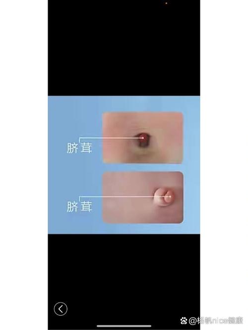新生儿肛门有个小疙瘩-第2张图片-郑州医学网