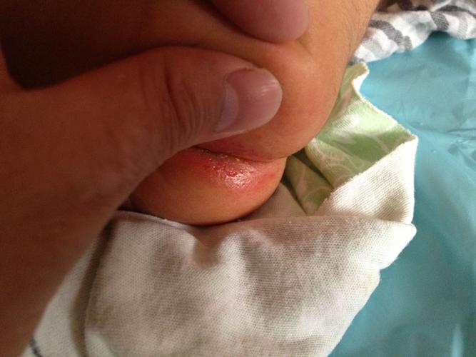 新生儿肛门有个小疙瘩-第3张图片-郑州医学网