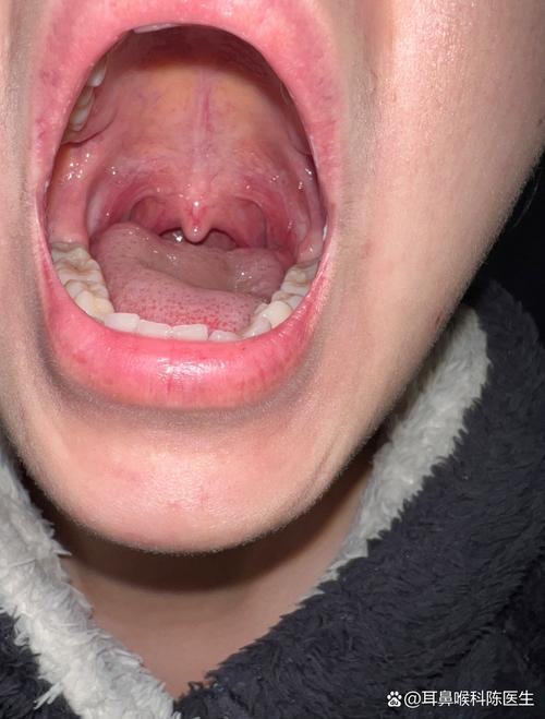 孕期喉咙反酸有灼烧感-第2张图片-郑州医学网 孕期喉咙反酸有灼烧感-第2张图片-郑州医学网