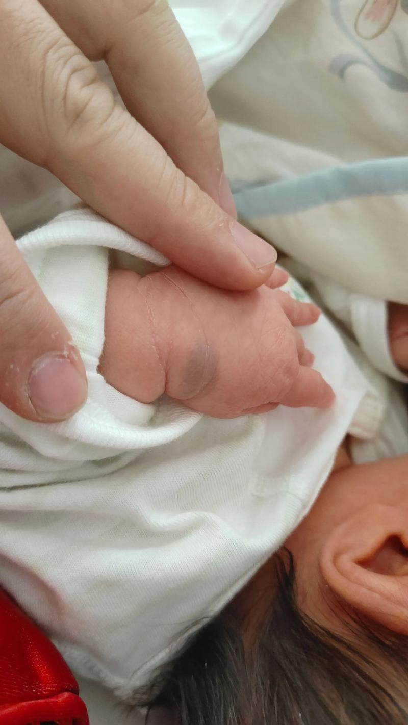 新生儿手腕血管瘤会自行消退吗?需要治疗吗?家长该如何护理?-第1张图片-郑州医学网 新生儿手腕血管瘤会自行消退吗?需要治疗吗?家长该如何护理?-第1张图片-郑州医学网