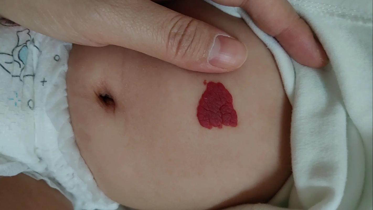 新生儿手腕血管瘤会自行消退吗？需要治疗吗？家长该如何护理？-第2张图片-郑州医学网