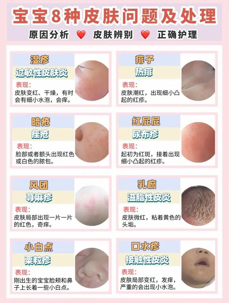 新生儿湿疹和痤疮区别-第1张图片-郑州医学网